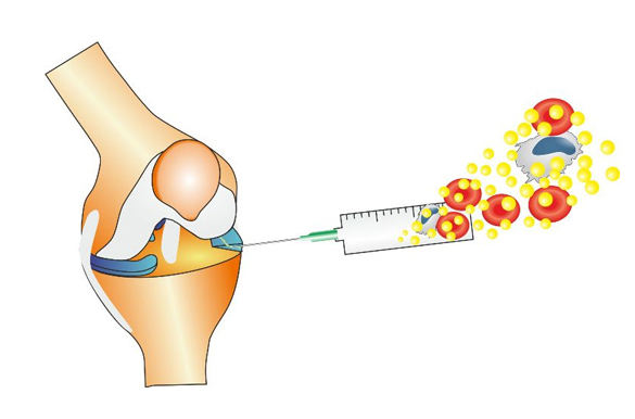 Knee Meniscus Tear