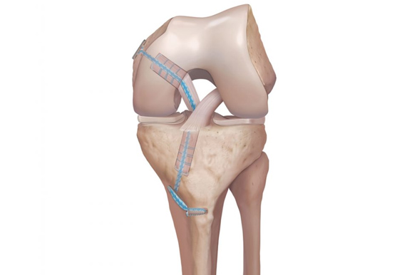 Posterior Cruciate Ligament Injury Surgery