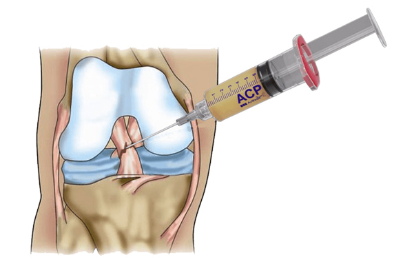 ACL Tear/Injury in Children