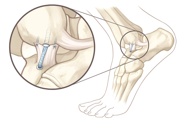 Internal Brace