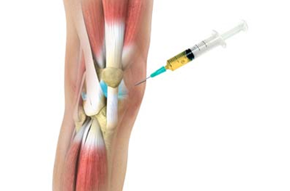 Osteochondral injury