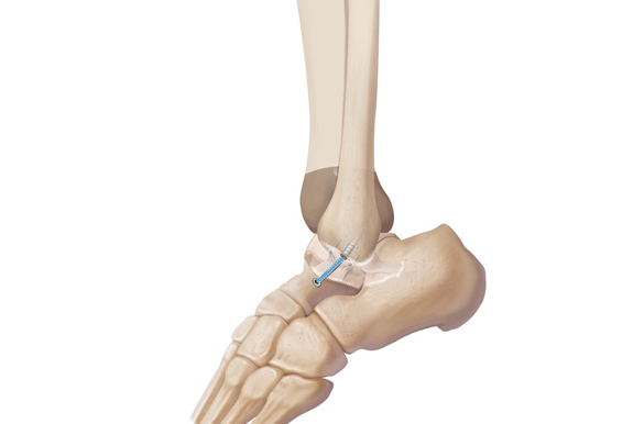 Ankle Ligament Tear