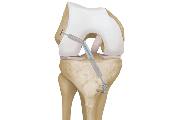 ACl Tear